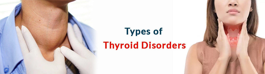 Types of Thyroid Disorders
